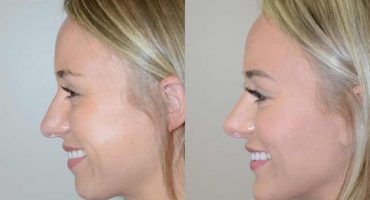 Burun Estetik Ameliyatı Rinoplasti